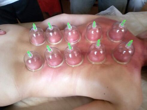 Το vacuum cupping είναι ένας εξαιρετικός τρόπος για τη θεραπεία του πόνου στη μέση στο σπίτι
